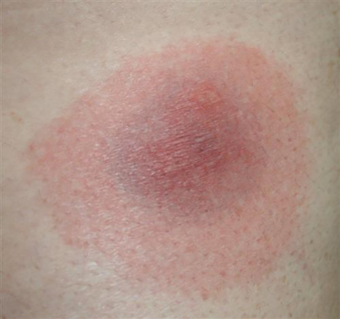 spider bite identification chart
