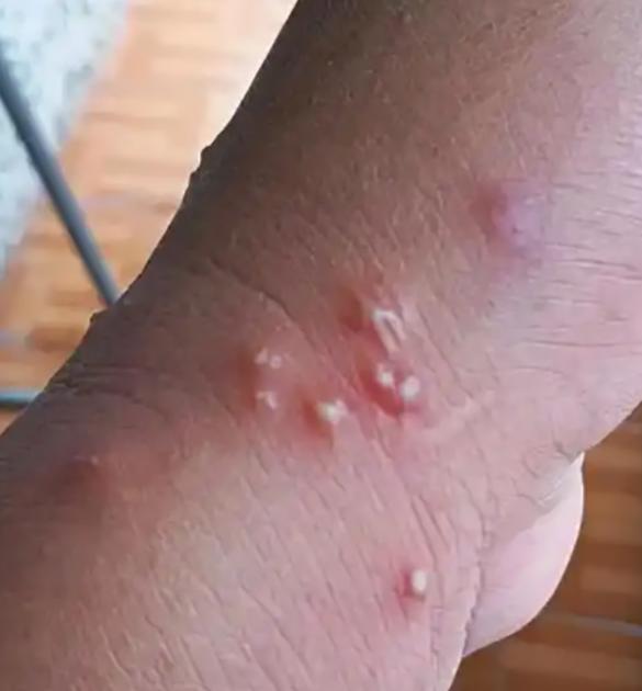 What Does a Fire Ant Bite Look Like